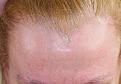 Click image for larger version

Name:	pk 6 mos post-op front.jpg
Views:	346
Size:	91.5 KB
ID:	475707