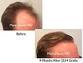 Click image for larger version

Name:	Hair Transplant Slides copy20.003.jpg
Views:	276
Size:	12.2 KB
ID:	475855
