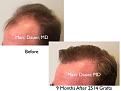 Click image for larger version

Name:	Hair Transplant Slides copy20.002.jpg
Views:	280
Size:	12.1 KB
ID:	475856