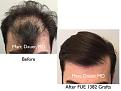 Click image for larger version

Name:	Hair Transplant Slides copy26.001.jpg
Views:	395
Size:	14.2 KB
ID:	475905