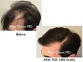 Click image for larger version

Name:	Hair Transplant Slides copy26.002.jpg
Views:	376
Size:	13.2 KB
ID:	475907