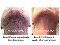 Click image for larger version

Name:	Hair Transplant Slides copy24.006.jpg
Views:	518
Size:	16.9 KB
ID:	475979