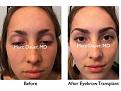 Click image for larger version

Name:	Hair Transplant Slides copy31.003.jpg
Views:	326
Size:	16.2 KB
ID:	476010