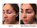Click image for larger version

Name:	Hair Transplant Slides copy31.002.jpg
Views:	313
Size:	15.3 KB
ID:	476011