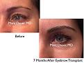 Click image for larger version

Name:	Hair Transplant Slides copy33.003.jpg
Views:	641
Size:	13.3 KB
ID:	477449
