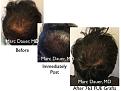 Click image for larger version

Name:	Hair Transplant Slides copy30.001.jpg
Views:	353
Size:	15.6 KB
ID:	477495