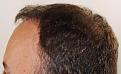 Click image for larger version

Name:	jc 10 months post L profile.jpg
Views:	338
Size:	91.0 KB
ID:	477519