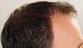 Click image for larger version

Name:	jc 10 months post R profile.jpg
Views:	331
Size:	97.7 KB
ID:	477521