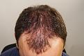 Click image for larger version

Name:	jc 10 months post chin down.jpg
Views:	363
Size:	96.9 KB
ID:	477523