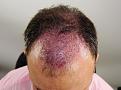 Click image for larger version

Name:	jc immediate post-op chin down.jpg
Views:	385
Size:	89.8 KB
ID:	477524