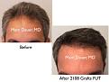 Click image for larger version

Name:	Hair Transplant Slides copy36.001.jpg
Views:	917
Size:	13.3 KB
ID:	477526