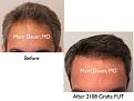 Click image for larger version

Name:	Hair Transplant Slides copy36.001.jpg
Views:	989
Size:	13.3 KB
ID:	477526