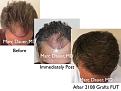 Click image for larger version

Name:	Hair Transplant Slides copy36.002.jpg
Views:	1002
Size:	16.0 KB
ID:	477527