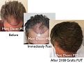Click image for larger version

Name:	Hair Transplant Slides copy36.002.jpg
Views:	1070
Size:	16.0 KB
ID:	477527