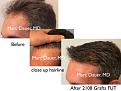 Click image for larger version

Name:	Hair Transplant Slides copy36.003.jpg
Views:	1108
Size:	15.9 KB
ID:	477528