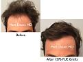 Click image for larger version

Name:	Hair Transplant Slides copy46.001.jpg
Views:	355
Size:	13.4 KB
ID:	477593