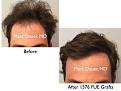 Click image for larger version

Name:	Hair Transplant Slides copy46.001.jpg
Views:	289
Size:	13.4 KB
ID:	477593