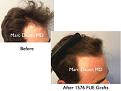Click image for larger version

Name:	Hair Transplant Slides copy46.003.jpg
Views:	249
Size:	12.9 KB
ID:	477595