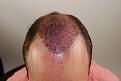 Click image for larger version

Name:	md imm post-op chin down .jpg
Views:	293
Size:	86.5 KB
ID:	477607