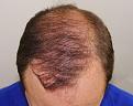Click image for larger version

Name:	md 1 year post-op chin down.jpg
Views:	327
Size:	95.4 KB
ID:	477608