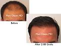 Click image for larger version

Name:	Hair Transplant Slides copy50.001.jpg
Views:	320
Size:	12.2 KB
ID:	477610