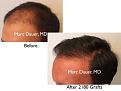 Click image for larger version

Name:	Hair Transplant Slides copy50.002.jpg
Views:	281
Size:	12.5 KB
ID:	477611