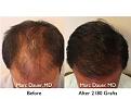Click image for larger version

Name:	Hair Transplant Slides copy50.004.jpg
Views:	321
Size:	15.0 KB
ID:	477613