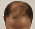 Click image for larger version

Name:	pre-op (1).JPG
Views:	468
Size:	46.7 KB
ID:	477627