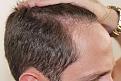 Click image for larger version

Name:	js 1.5 year post-op R profile.jpg
Views:	359
Size:	95.9 KB
ID:	477643