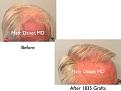 Click image for larger version

Name:	Hair Transplant Slides copy7.003.jpg
Views:	284
Size:	11.7 KB
ID:	477659