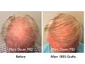 Click image for larger version

Name:	Hair Transplant Slides copy7.004.jpg
Views:	285
Size:	15.0 KB
ID:	477660