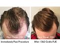 Click image for larger version

Name:	Hair Transplant Slides copy11.001.jpg
Views:	345
Size:	18.6 KB
ID:	477698