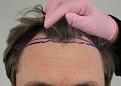 Click image for larger version

Name:	pre-op (1).JPG
Views:	589
Size:	80.1 KB
ID:	477784