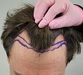 Click image for larger version

Name:	pre-op (4).jpg
Views:	595
Size:	40.5 KB
ID:	477787