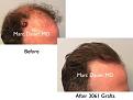 Click image for larger version

Name:	Hair Transplant Slides copy15.003.jpg
Views:	346
Size:	12.5 KB
ID:	477802