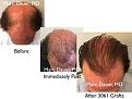 Click image for larger version

Name:	Hair Transplant Slides copy15.004.jpg
Views:	444
Size:	15.5 KB
ID:	477804