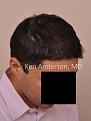 Click image for larger version

Name:	Anderson Center for Hair Restoration Transplant (7).jpg
Views:	504
Size:	45.3 KB
ID:	477810