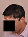 Click image for larger version

Name:	Anderson Center for Hair Restoration Transplant (6).jpg
Views:	562
Size:	47.9 KB
ID:	477811