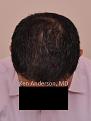 Click image for larger version

Name:	Anderson Center for Hair Restoration Transplant (5).jpg
Views:	551
Size:	42.1 KB
ID:	477812