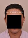 Click image for larger version

Name:	Anderson Center for Hair Restoration Transplant (4).jpg
Views:	513
Size:	25.0 KB
ID:	477813