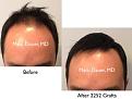 Click image for larger version

Name:	Hair Transplant Slides copy30.003.jpg
Views:	295
Size:	12.6 KB
ID:	477889
