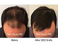 Click image for larger version

Name:	Hair Transplant Slides copy30.004.jpg
Views:	318
Size:	15.5 KB
ID:	477890
