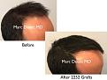 Click image for larger version

Name:	Hair Transplant Slides copy30.001.jpg
Views:	305
Size:	12.1 KB
ID:	477892