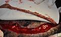 Click image for larger version

Name:	left intraop 3.jpg
Views:	492
Size:	95.8 KB
ID:	477925