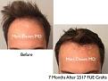 Click image for larger version

Name:	Hair Transplant Slides copy25.001.jpg
Views:	384
Size:	13.7 KB
ID:	477933