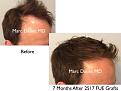 Click image for larger version

Name:	Hair Transplant Slides copy25.003.jpg
Views:	342
Size:	13.9 KB
ID:	477935