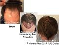 Click image for larger version

Name:	Hair Transplant Slides copy25.004.jpg
Views:	446
Size:	17.7 KB
ID:	477936