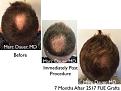 Click image for larger version

Name:	Hair Transplant Slides copy25.005.jpg
Views:	298
Size:	17.1 KB
ID:	477937
