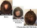 Click image for larger version

Name:	Hair Transplant Slides copy25.005.jpg
Views:	367
Size:	17.1 KB
ID:	477937