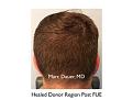 Click image for larger version

Name:	Hair Transplant Slides copy25.006.jpg
Views:	266
Size:	12.2 KB
ID:	477938
